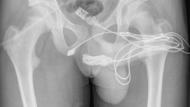 USB cord stuck in penis