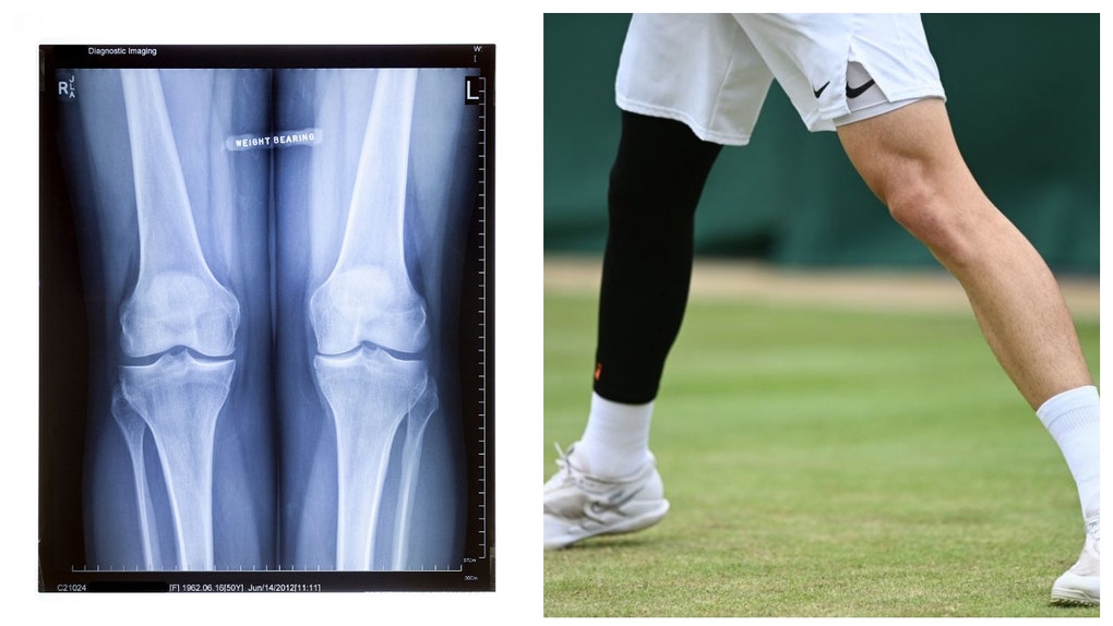 LEG SURGERY