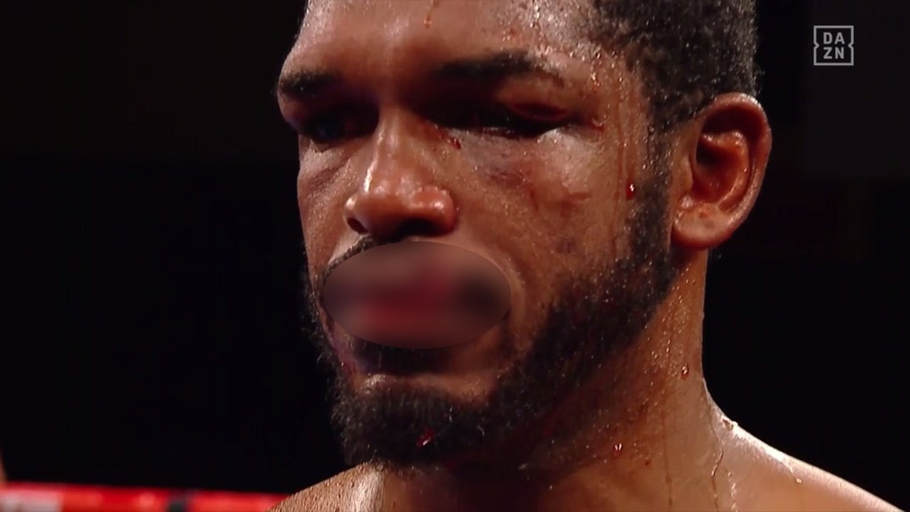 Tureano Johnson cut lip