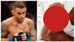 UFC fighter Dustin Poirier shares look at staph infection. (Credit: Getty Images and Dustin Poirier/Twitter)
