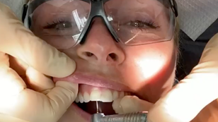 Lindsey Vonn teeth fixed