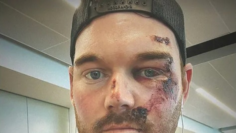 Grayson Murray Receives 50 Stitches After Gruesome Scooter Accident