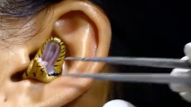 Snake stuck in ear video
