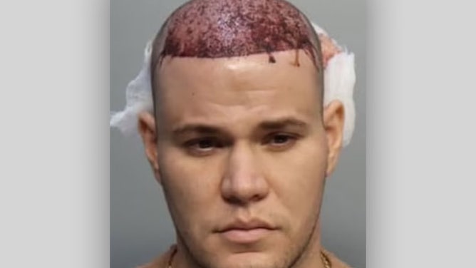 bloody Hair Transplant airline passenger